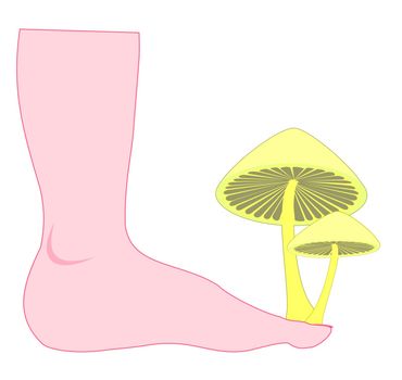 athlete's foot  (Tinea pedis)
