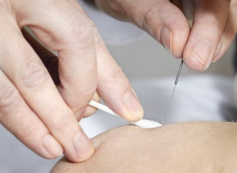 Closeup of acupuncture needle being removed from skin