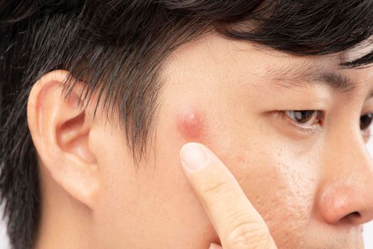 Close up photo of acne prone skin, a man squeezing his pimple