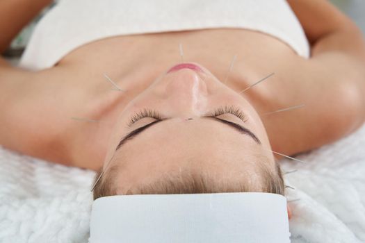 Young woman having an acupuncture treatment therapy on her face in spa salon. Alternative medicine and therapy concept