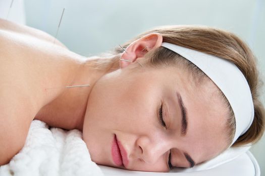 Beautiful woman relaxing on a bed having acupuncture treatment with needles in and around her ear. Alternative Therapy concept