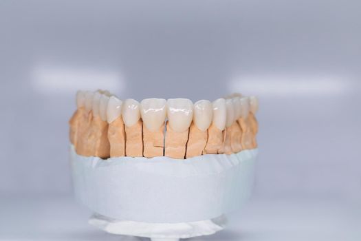Ceramic tooth crown on plaster model. Finished new ceramic bridge on plaster model, frontal view. Dental veneers are lying on a wite background in the laboratory