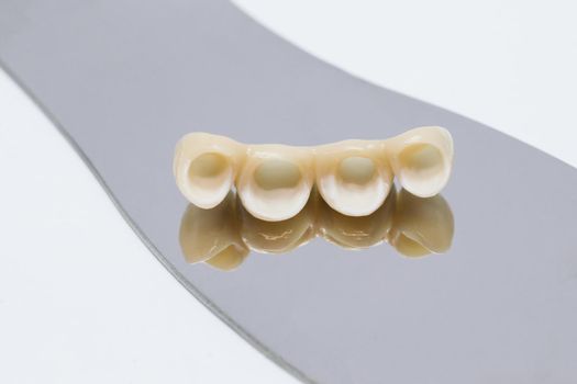 Metal free ceramic dental crowns. Dental ceramic veneers and crowns.