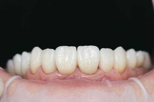 Dental health care. Ceramic zirconium in final version. Staining and glazing. Precision design and high quality materials
