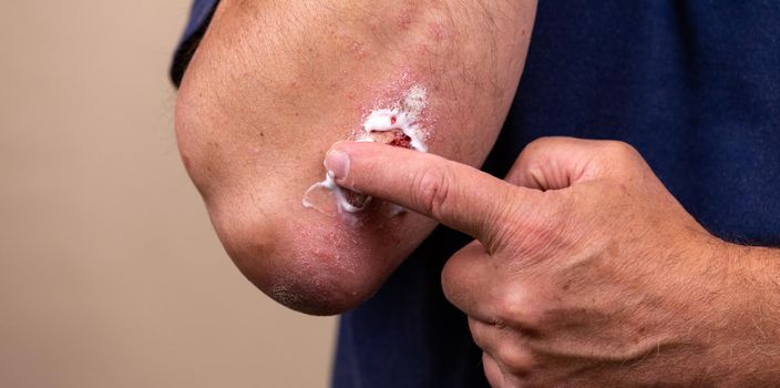 Concept photo of treatment of skin diseases using ointments as dosage form of drug. Patient causes medical therapeutic ointment thick consistency or cream moisturizer on skin in elbow area close-up