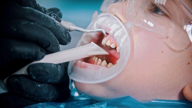 A little boy with baby teeth having a cleaning treatment in the dentistry