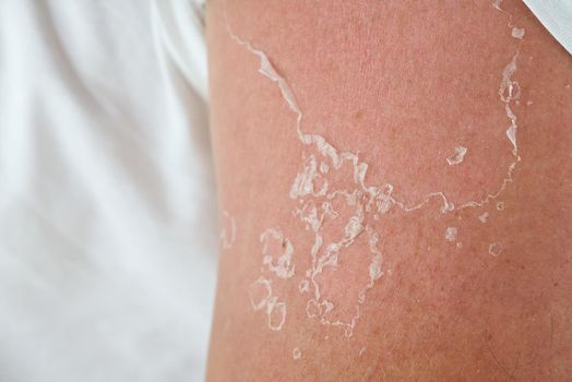 peeling of skin after burned by sunlight. not using sunscreen