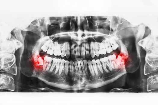 X-ray image of oral cavity with growing lower wisdom teeth on white background