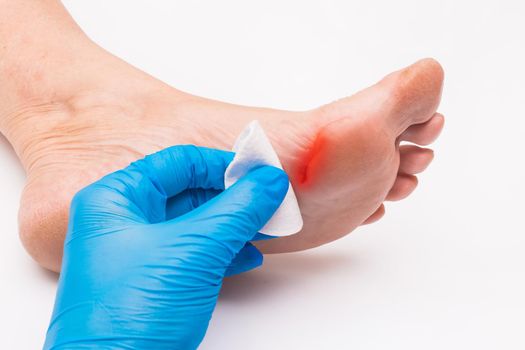 Doctor's hand in a protective medical glove applies a cotton pad to the wound on the foot, woman's leg on a white background, close-up