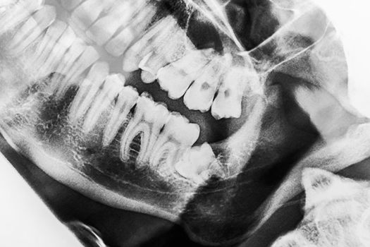 X-ray scan picture of wisdom teeth dentistry close-up