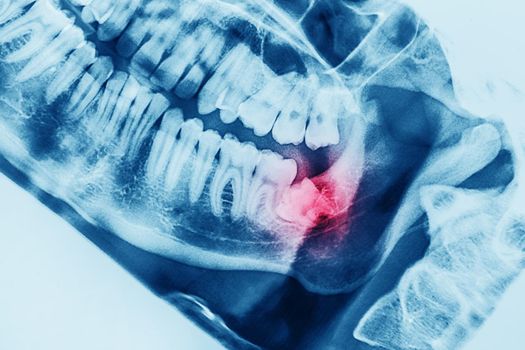 X-ray oral image with an inflamed wisdom tooth close-up