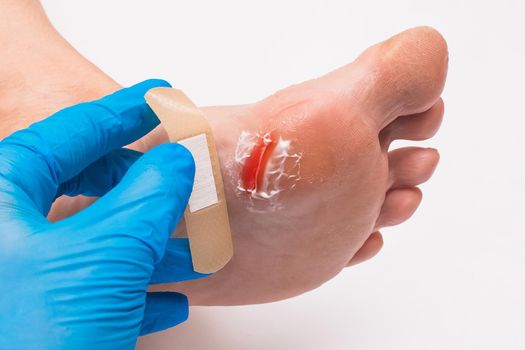 Doctor's hand in a protective medical glove seals the wound on the foot, woman's leg with a plaster on a white background, close-up