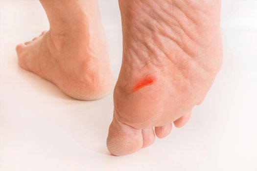 Legs of an elderly woman with a wound on the foot on a white background, close-up
