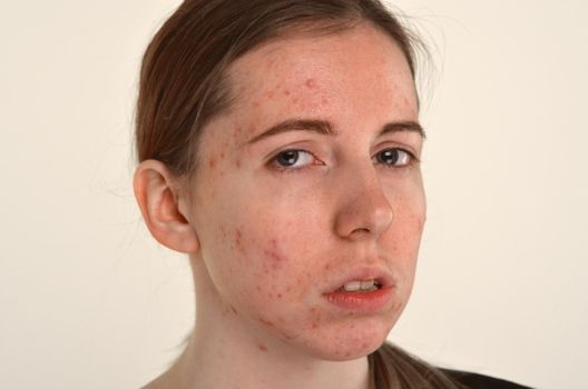 beautiful young girl with problematic skin, acne problem concept
