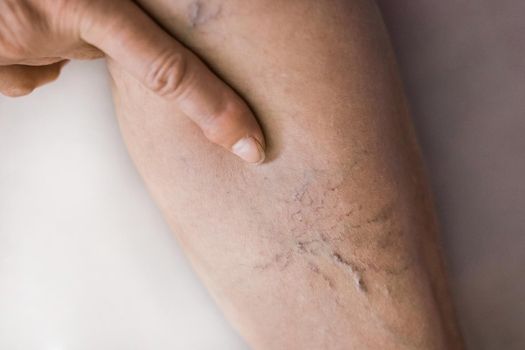 The finger of an elderly woman shows on varicose veins, sick female legs