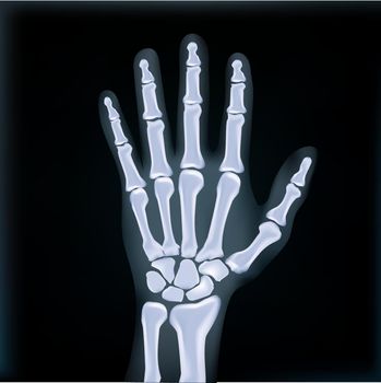 Realistic X-ray Hand Medical Image