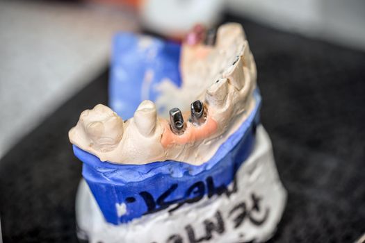 Dental implants in dental model