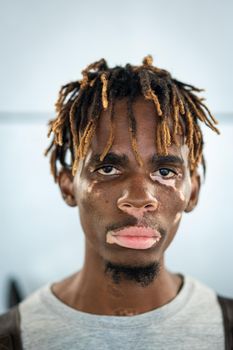 African American black young man with vitiligo skin pigment issue