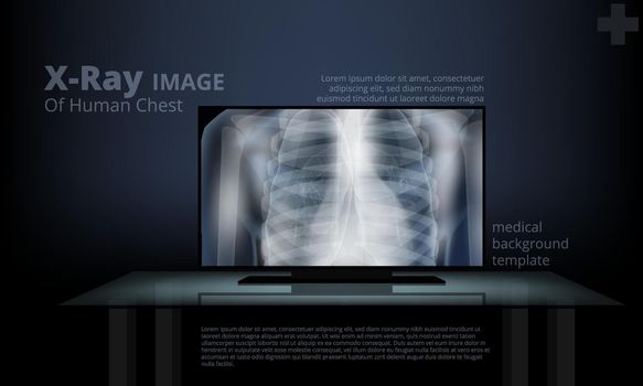 X-Ray Image Of Human Chest On Computer Screen