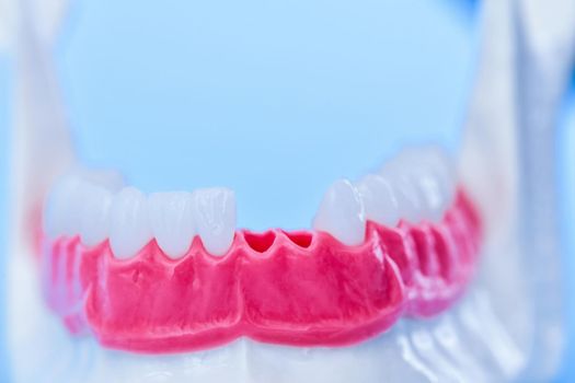 Tooth implant and crown installation process