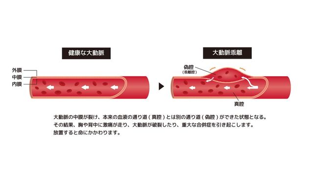 Comparison illustration of normal aorta and aortic dissection  (Japanese)