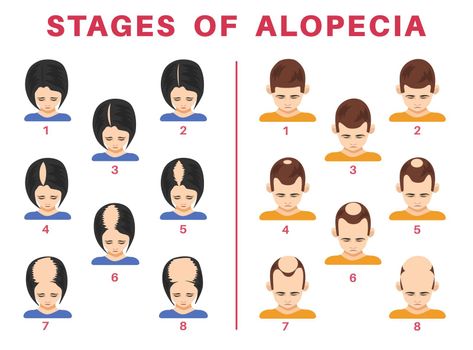 Stages of alopecia in men and women vector illustrations set