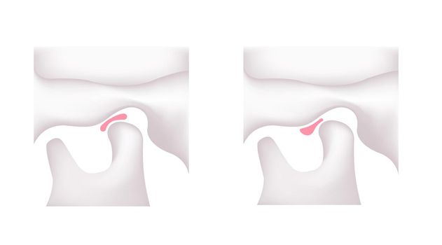 Illustration comparing the shapes of the articular disk ( normal jaw and Temporomandibular disorders )
