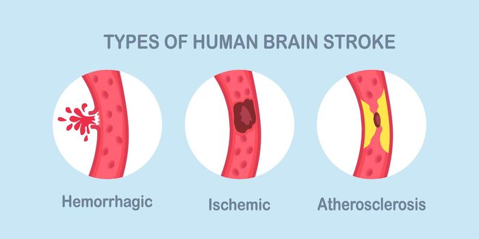Types of human brain stroke. Ischemic, atherosclerosis and hemorrhagic stroke disease
