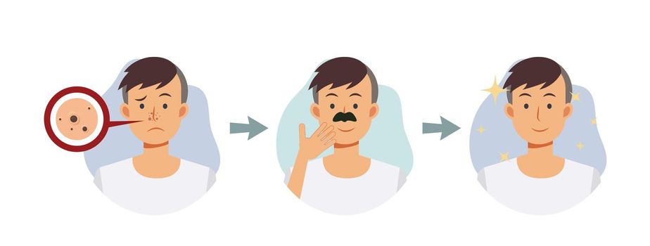facial skin treatment concept,acne problem.acne on nose.step of A man remove acne from his nose. flat vector cartoon character illustration.
