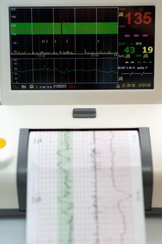 Electronic Cardiotocography Machine Monitoring Fetal Heart Contractions Of Uterus. Printing Cardiogram Report Coming Out Electrocardiogram In Labor Ward During Pregnancy. Medical Diagnostic Equipment