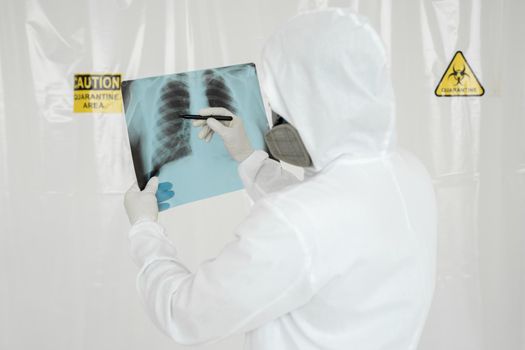 Epidemiologist draws a marker on the x-ray lung lesion covid-19. Coronavirus concept.