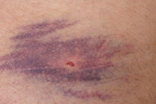Closeup of bruise over white skin