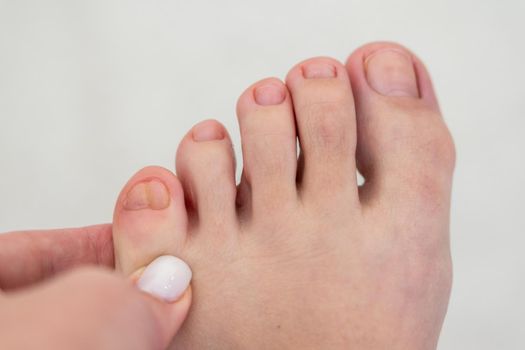 Woman touching her deformed double little toe