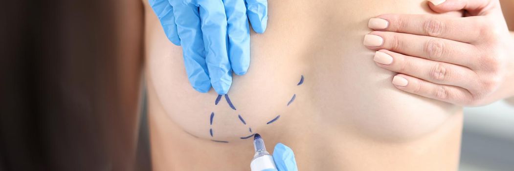 Plastic surgeon drawing preoperative markings on patient chest closeup