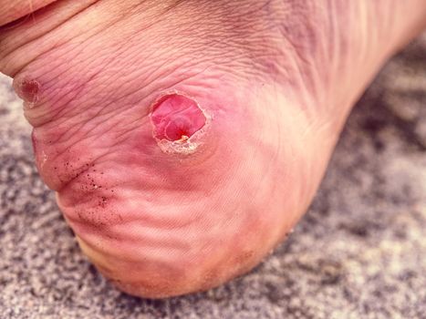 Naked foot with painful Heel wound in nature. Man feet 