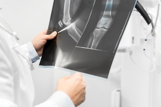 Doctor examine a film x-ray of a patient at radiology room.
