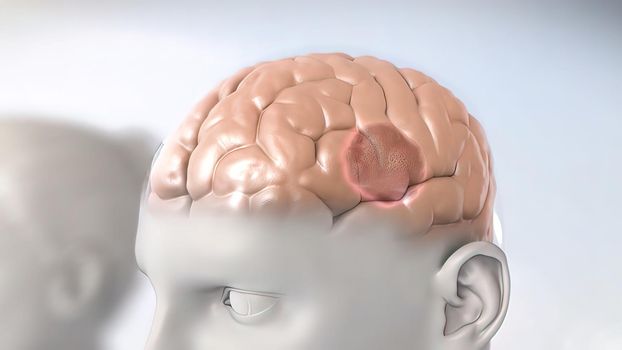 A brain tumor is a collection or mass of abnormal cells in your brain.