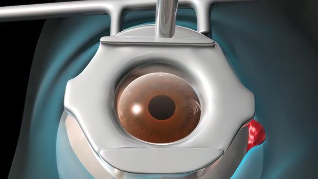 Cataract surgery application view Surgical operations on the human eye
