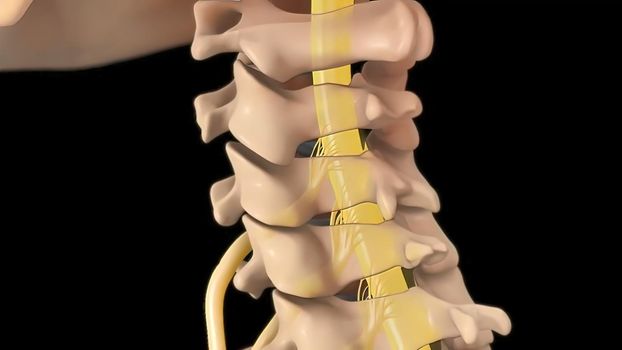 Anatomical view of the cervical spine with intervertebral disc-compressive nerve root prolapse