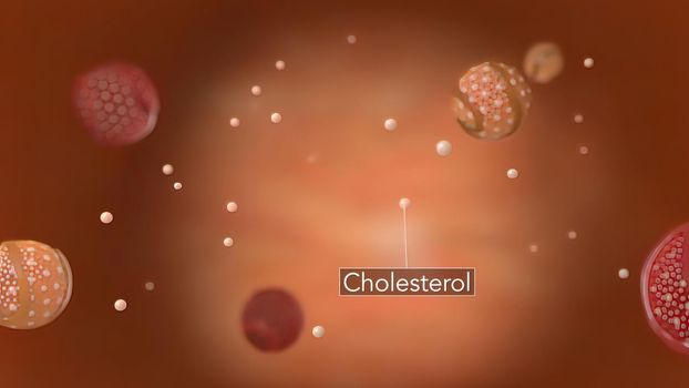 Atherosclerosis, Cholesterol And Other Substances In And On The Artery Walls.