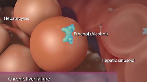 Chronic liver failure caused by the hepatitis B virus.