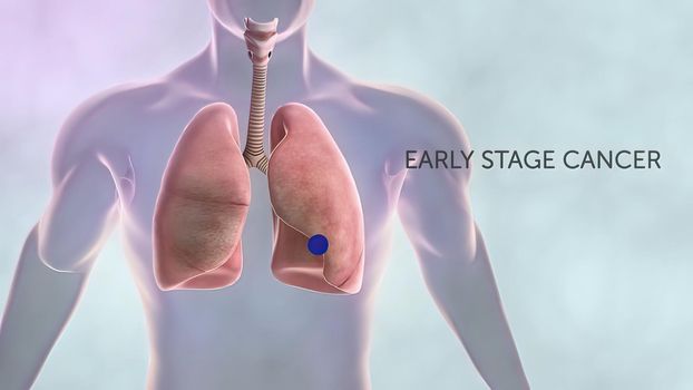Early stage cancer and advanced stages of cancer.