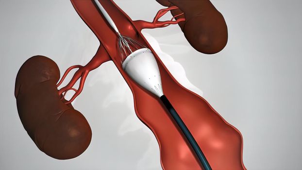 balloon angioplasty procedure with stent in vein
