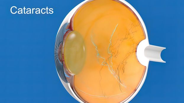 Cataract, clouding of the lens of the eye that causes decreased vision.