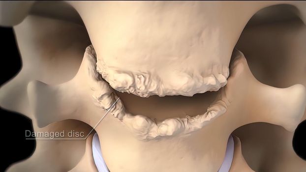 3D medical illustration of cervical spine on black background