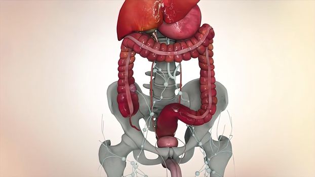 3D Medical of colon cancer. Tumor growth