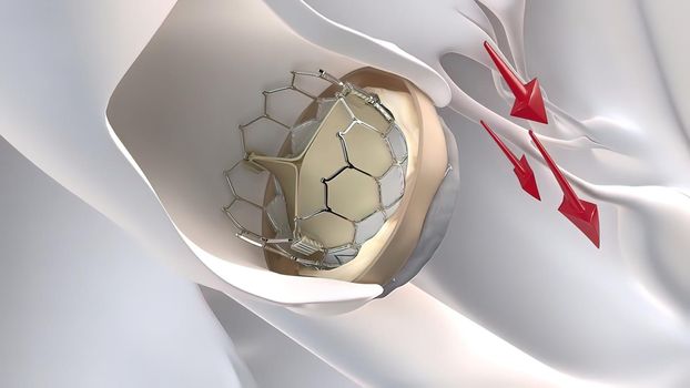 The Cardiovascular System. 3D Medical 3D illustration of the Aortic Valve Epansion