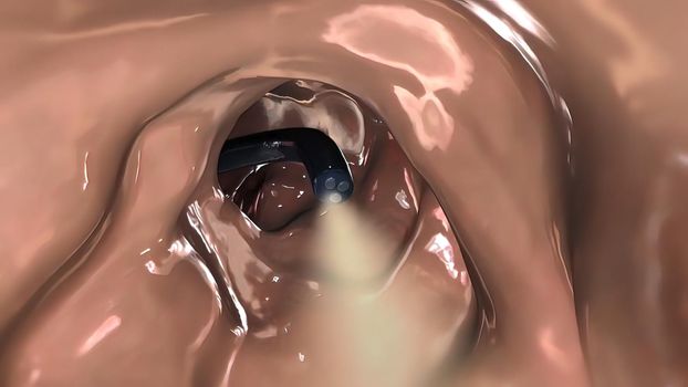 Colonoscopy Biopsy Of The Gastrointestinal Tract In Patients