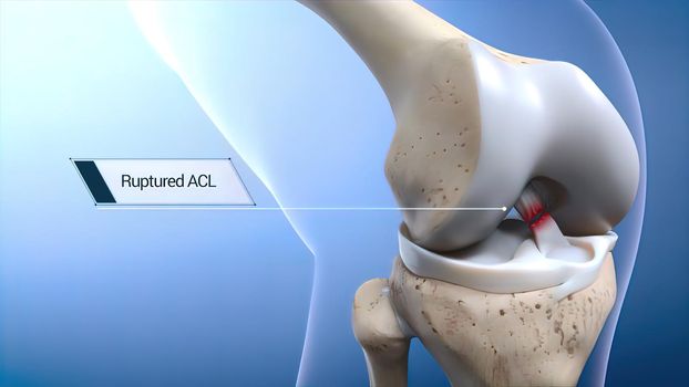 Anterior Cruciate Ligament (ACL) Injury or Tear