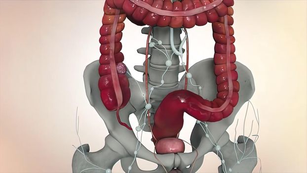 Colon during a enteroscopy with a intestinal or bowel cancer tumor visible.